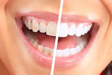Береги зубы смолоду! Профессиональная чистка зубов Air Flow + ультразвук со скидкой 70% в стоматологии «Санта VII»!